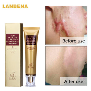 Acne Scar Removal Cream